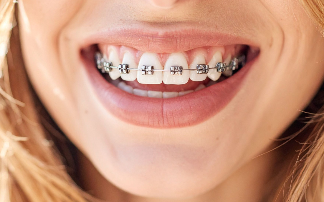 duele_ponerse_brackets