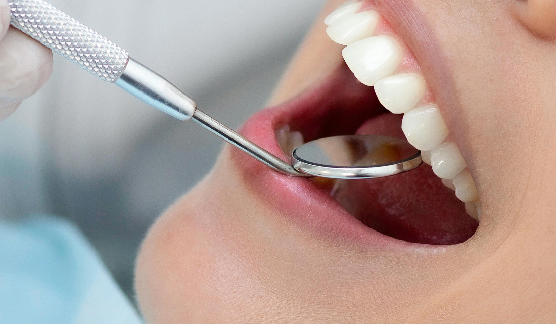 se_puede_comer_despues_de_un_empaste