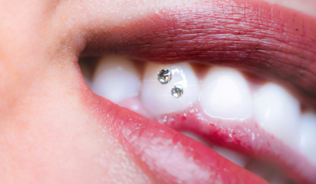 piercing_dental_madrid