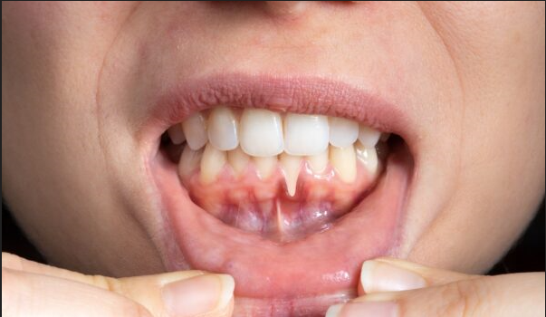 Periodontitis_sintomas_causas