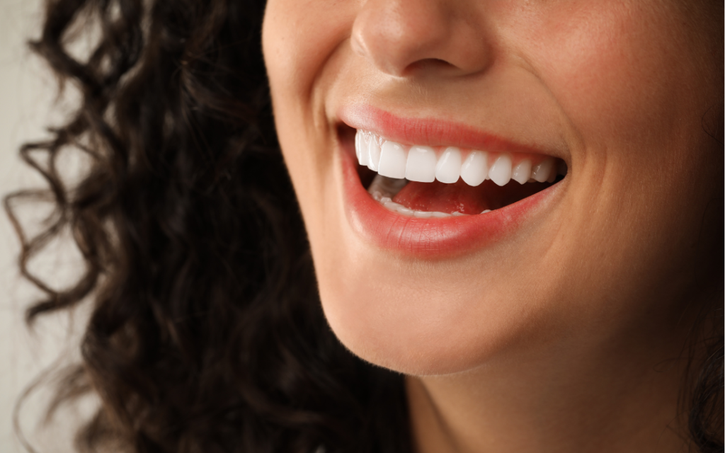 carillas_dentales
