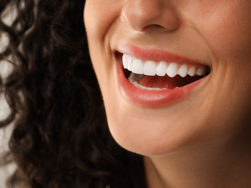 carillas_dentales