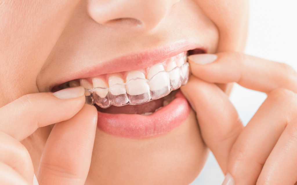 invisalign