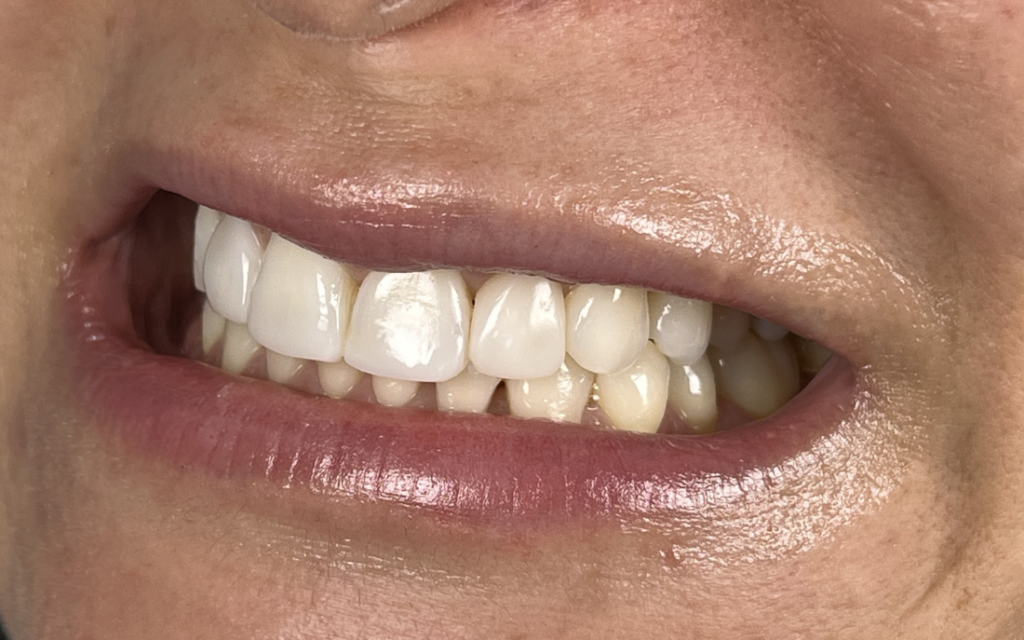 blanqueamiento_dental