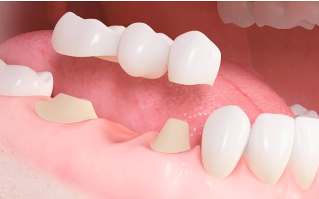 puente_dental