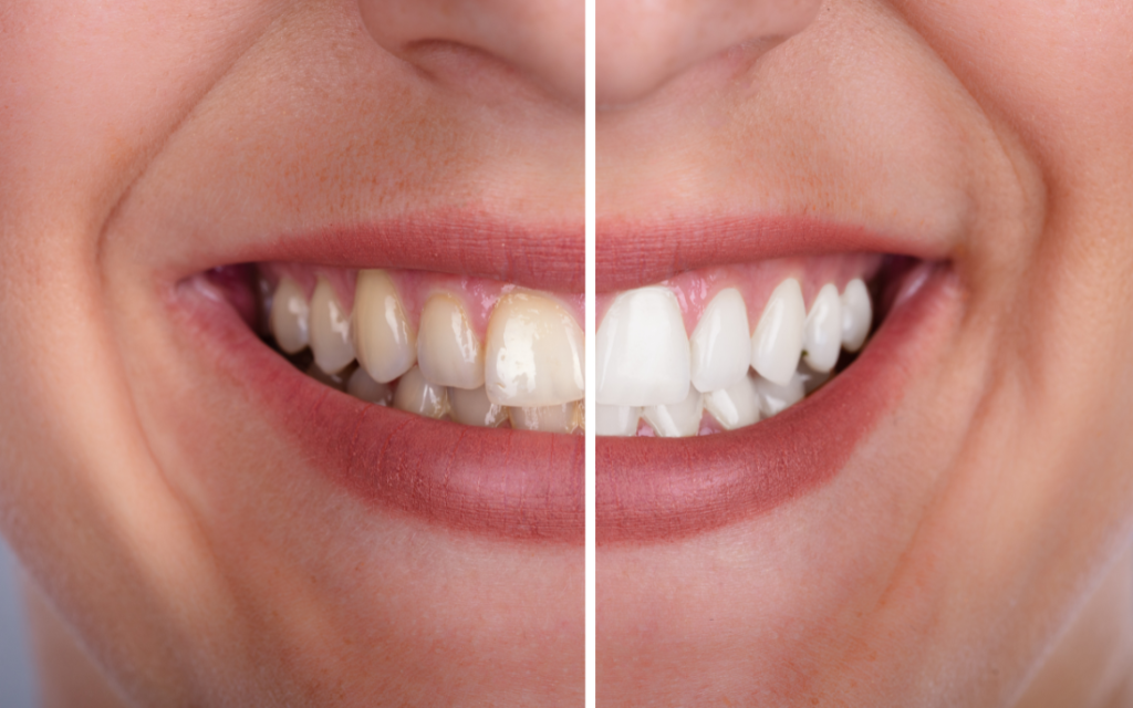 que_es_blanqueamiento_dental